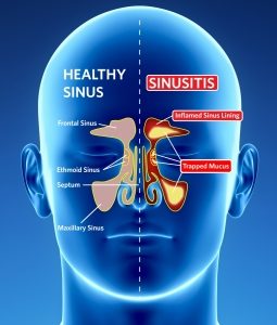 Sinus Disorders - Dr. Matthew L. Finerman